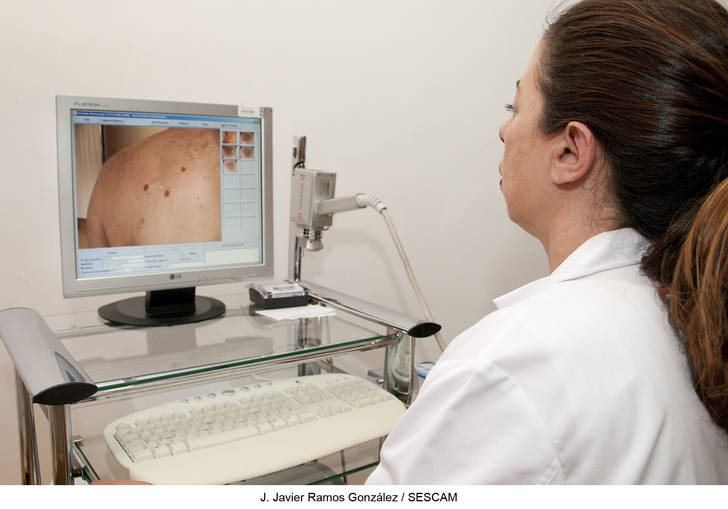 La exposición excesiva al sol, causante de entre un 50 y un 90 por ciento de los casos de cáncer de piel