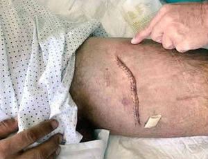 Iván Fandiño se recupera de la cornada sufrida en Úbeda