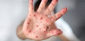 Guadalajara registra un brote epidemiológico de sarampión