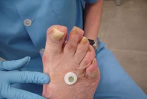 Los podólogos de Castilla-La Mancha advierten de los riesgos de la compra en supermercados y por internet de callicidas