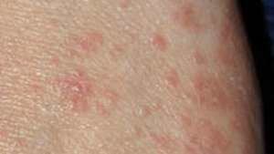 Brote de sarna en una Residencia de Mayores de Castilla La Mancha