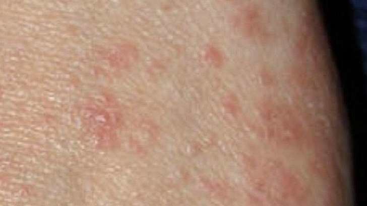 Brote de sarna en una Residencia de Mayores de Castilla La Mancha